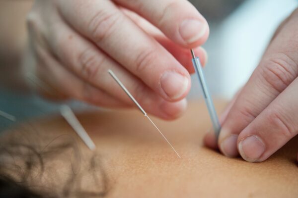 Hvordan akupunktur kan lindre smerter i ryggen og lænden